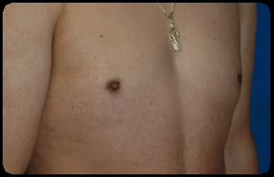 Liposuction and Body Contouring - Suction Assisted Lipectomy (SAL) 