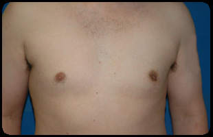 Liposuction and Body Contouring - Suction Assisted Lipectomy (SAL) 