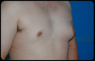 Liposuction and Body Contouring - Suction Assisted Lipectomy (SAL) 