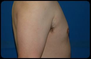 Liposuction and Body Contouring - Suction Assisted Lipectomy (SAL) 