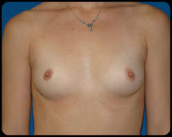 Breast Surgery - Mammoplasty and Mastoplasty 