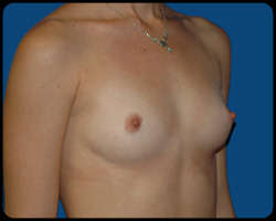 Breast Surgery - Mammoplasty and Mastoplasty 