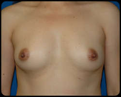 Breast Surgery - Mammoplasty and Mastoplasty 