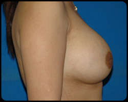 Breast Surgery - Mammoplasty and Mastoplasty 