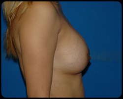 Breast Surgery - Mammoplasty and Mastoplasty 