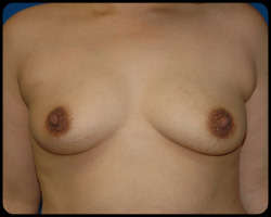 Breast Surgery - Mammoplasty and Mastoplasty 