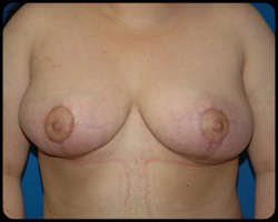 Breast Surgery - Mammoplasty and Mastoplasty 