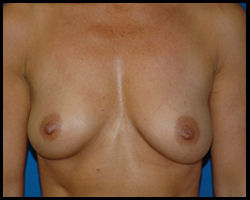 Breast Surgery - Mammoplasty and Mastoplasty 