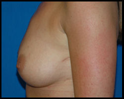 Breast Surgery - Mammoplasty and Mastoplasty 