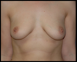 Breast Surgery - Mammoplasty and Mastoplasty 