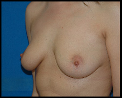 Breast Surgery - Mammoplasty and Mastoplasty 