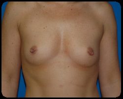 Breast Surgery - Mammoplasty and Mastoplasty 