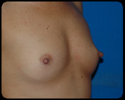 Breast Surgery - Mammoplasty and Mastoplasty 