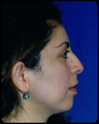 Nasal Surgery - Rhinoplasty 