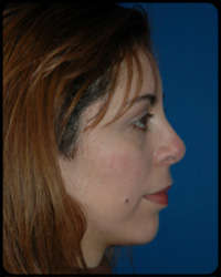 Nasal Surgery - Rhinoplasty 