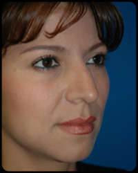 Nasal Surgery - Rhinoplasty 