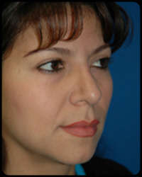 Nasal Surgery - Rhinoplasty 