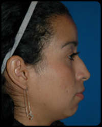 Nasal Surgery - Rhinoplasty 