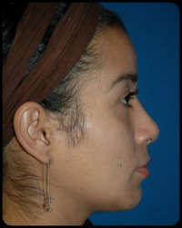 Nasal Surgery - Rhinoplasty 