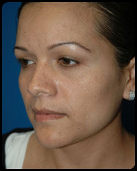 Nasal Surgery - Rhinoplasty 