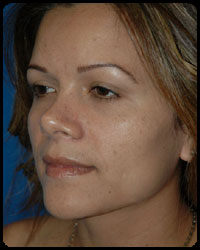 Nasal Surgery - Rhinoplasty 