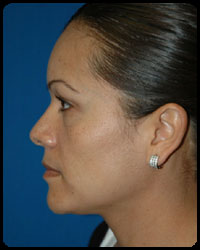 Nasal Surgery - Rhinoplasty 