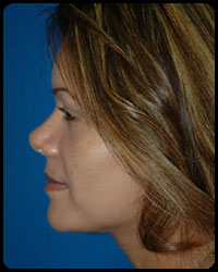 Nasal Surgery - Rhinoplasty 