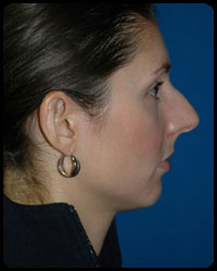 Nasal Surgery - Rhinoplasty 