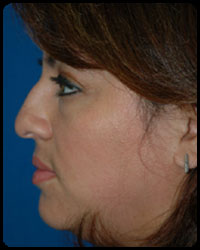 Nasal Surgery - Rhinoplasty 