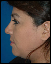 Nasal Surgery - Rhinoplasty 