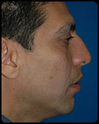 Nasal Surgery - Rhinoplasty 